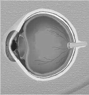 conditions Chronic vision loss Basic eye exam Red eye Eyelids Blepharitis Conjunctiva Dry eye syndrome Intraocular Acute glaucoma Stye /