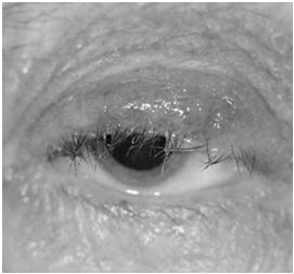 Eyelids Eyelids Blepharitis Conjunctiva Dry eye syndrome Intraocular Acute glaucoma