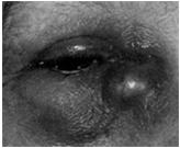 excision/drainage Dacryocystitis Inflammation of lacrimal sac Hot nodule next to nose