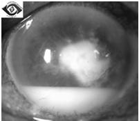 Bacterial keratitis Infection of the cornea Presentation Photophobia