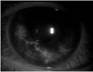 Antivirals Topical or systemic Conjunctiva Eyelids Blepharitis Conjunctiva