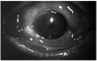 RX: Patanol Cromolog Bacterial conjunctivitis Rare and self-limited in