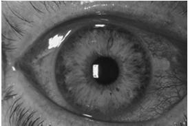 Viral conjunctivitis Pink eye Adenovirus