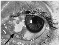 cornea Self-limited Lubricant eye drops