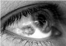 proliferation of palpebral conjunctiva Usually