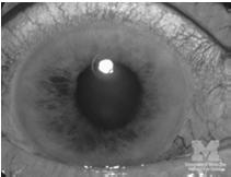 Intraocular Acute glaucoma Eyelids Conjunctiva Blepharitis Dry eye