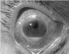 Inflammation inside eye Uveitis (iris, ciliary body, choroid)