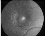 Uveitis / Iritis Endophthalmitis Infection inside eyeball Red,