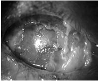 Triage PCP Blepharitis Stye Corneal abrasion Dry eyes Allergic conjunctivitis Viral conjunctivitis Bacterial conjunctivitis Pingueculitis Pterygium Subconjunctival heme Preseptal cellulitis REFERRAL