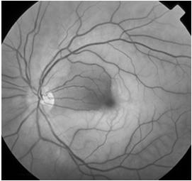 Chemical to eye Severity of alkali burn is judged by corneal opacification size of epithelial defect, limbal ischemia/whitening Airbag deployment can release alkali check ph TAKE HOME MESSAGE Acute
