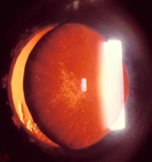 Trauma: Blunt Injury Lens dislocation
