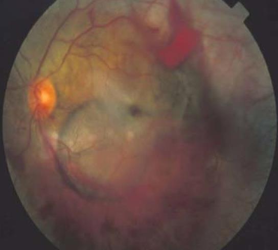 Traumatic macular hole