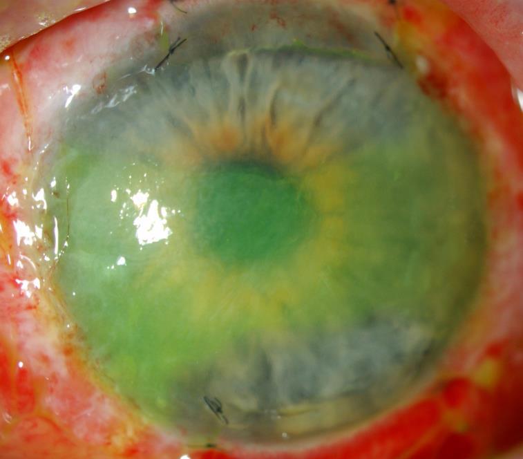 infection Scarring, symblepharon PLUS: deeper damage: cataract,