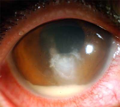 Microbial keratitis Symptoms: Lacrimation Photophobia Irritation or pain Reduced vision