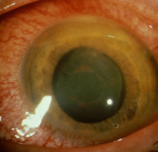 Acute Angle Closure Glaucoma Physical findings include increased Intra Ocular Pressure