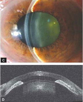 Acute Angle Closure Glaucoma Risk