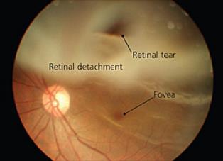 Retinal Detachment: Separation of neural retina from the RPE Separates photoreceptors from their blood supply Early diagnosis and