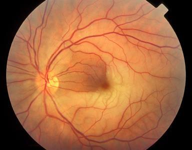 Retinal Artery Occlusion Painless and sudden loss of vision in one eye.