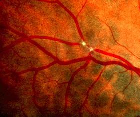 CRAO or BRAO Retinal artery occlusion Embolic: carotid or cardiac:
