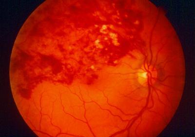 Retinal vein occlusion Central or branch vein occlusion Often a delay to present Blood and thunder fundus Measure BP,