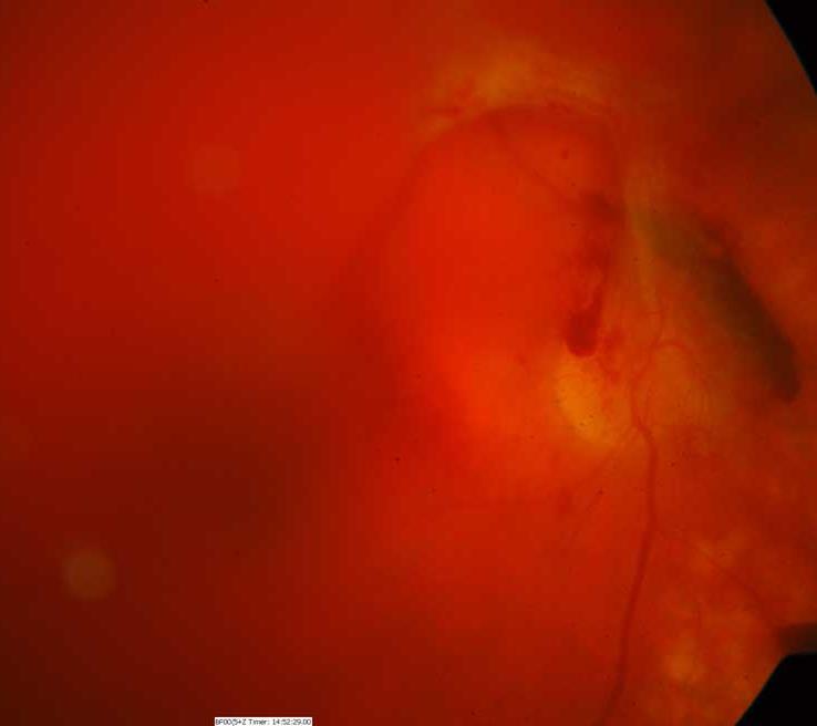 Painless vision loss Loss of red reflex No APD usually Vitreous hemorrhage Bleeding