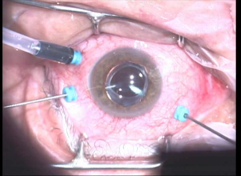 Sudden Visual Loss: Endophthalmitis Post cataract: 1 in 1000 incidence Post intravitreal avastin injection: 1 in 200 Emergency