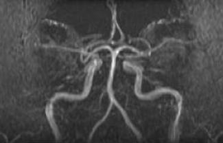 Angiogram: Magnetic Resonance Angiography of the