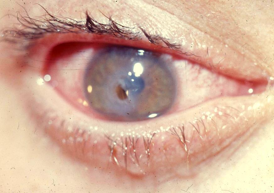 uninjured eye) Irregular or