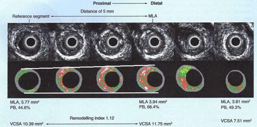 IVUS Gray-Scale and Corresponding Virtual Histology Frames MLA: Minimum luminal area; PB: Plaque burden; VCSA: Vessel cross-sectional area.