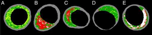 Dynamic Nature of Coronary Plaque Morphology Baseline and 12-month follow-up VH-IVUS studies of 216