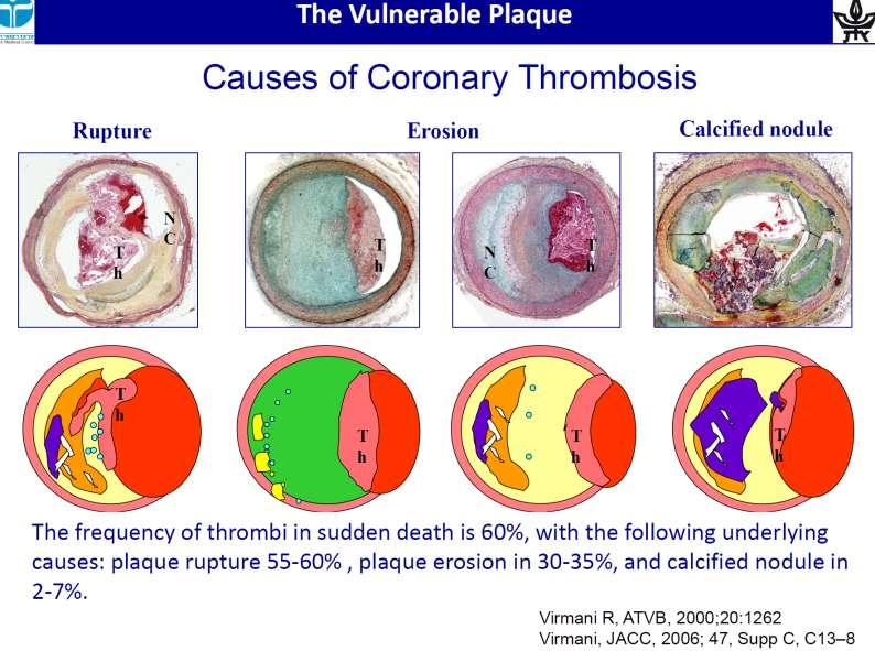 Causes of Coronary Thrombosis Rupture Erosion Calcified nodule Virmani R,