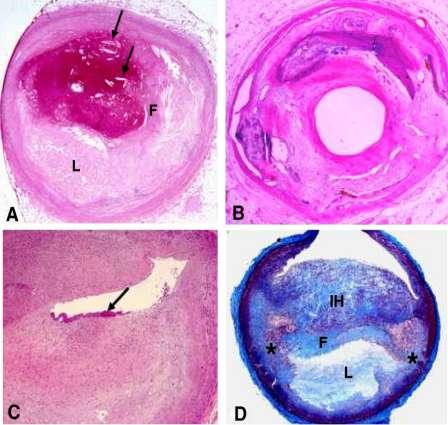 Characteristics of Thrombosed Plaques Plaque rupture Thin fibrous cap (95% 64 μm) Large necrotic core Increased plaque inflammation Positive vascular remodeling Vasa vasorum neovascularization