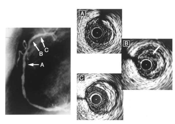 IVUS Morphology of Vulnerable Coronary Plaque 114 coronary sites without significant stenosis by angiography (<50% diameter stenosis) in 106 patients undergoing ICA and IVUS were examined.