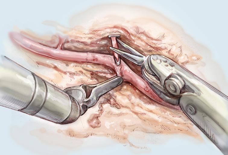 The most beneficial portion of traditional bypass surgery, the LIMA-to-LAD graft, can be performed using a minimally invasive technique.
