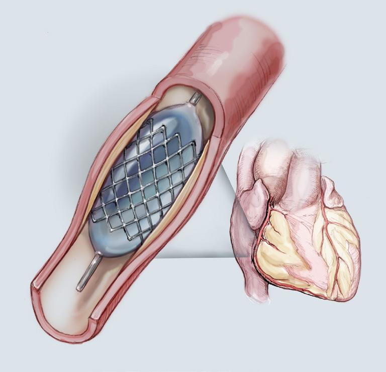 PCI is a safe, effective procedure used to treat mild or moderate coronary artery disease.