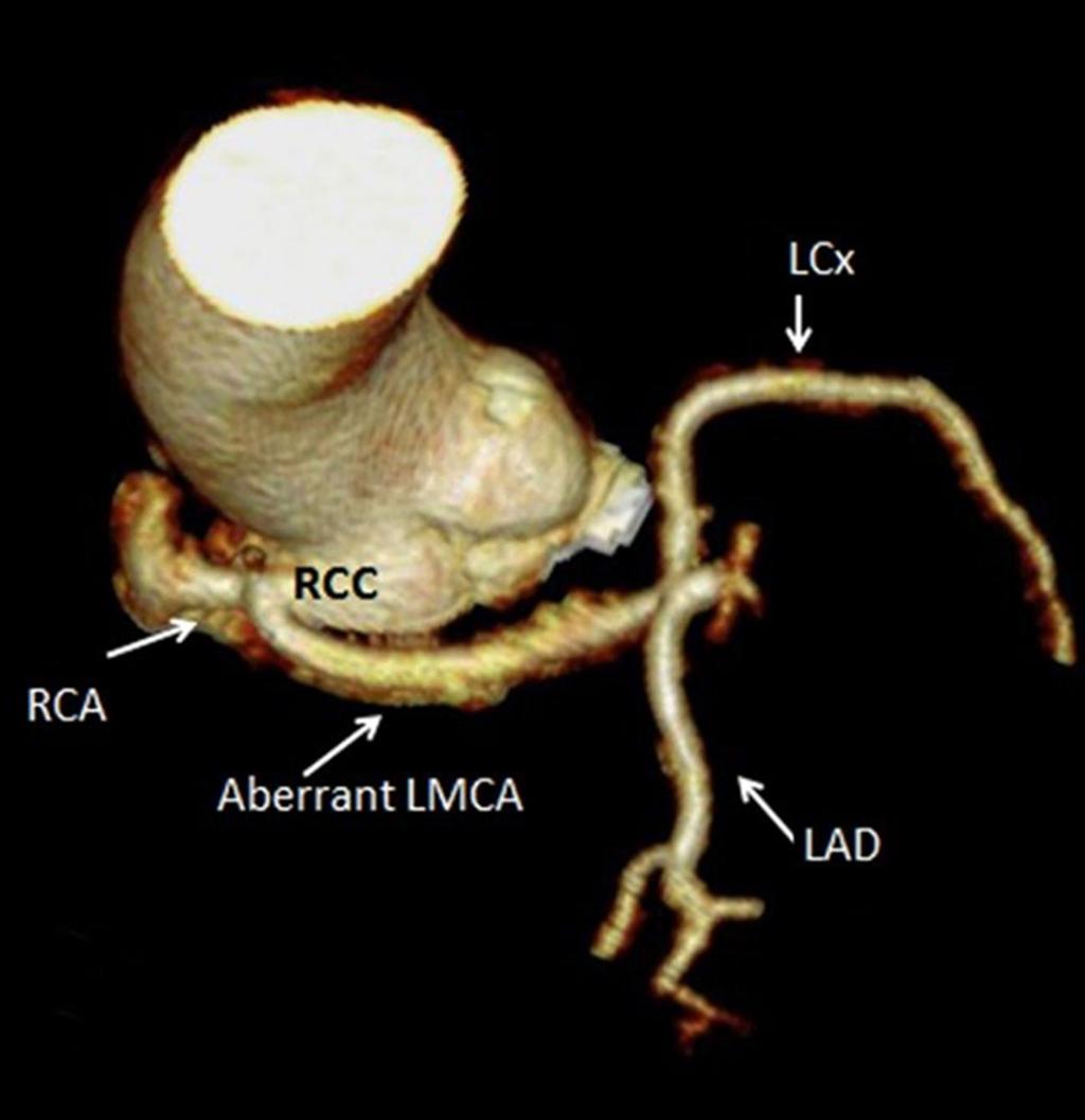 Cardiol Ther (2015) 4:77 82 79 Fig. 2 Cardiac computed tomography pre-cardiac surgery showing the anomalous (aberrant) left main coronary artery (LMCA) arising from the right coronary cusp.