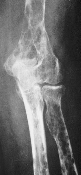 The RANK/RANKL/OPG Pathway in Osteolytic Bone Disease