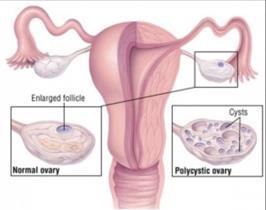 Understand the clinical manifestations and pathologic features of polycystic ovarian disease. Polycystic Ovarian disease (PCOD): Polycystic ovaries are characterized by: 1.