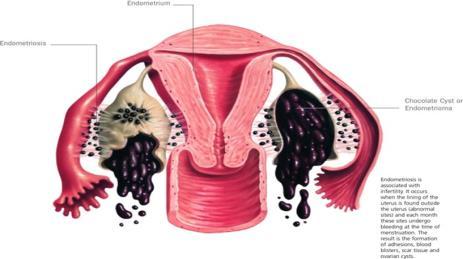 Endometriosis is the presence of ectopic endometrial glands and stroma outside the uterus.