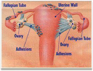 May recur after surgical excision but the risk is low. Complications: Infertility.