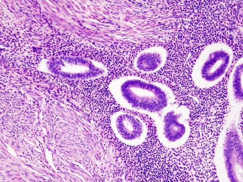 o o Macrophages containing hemosiderin (siderophages) are present.