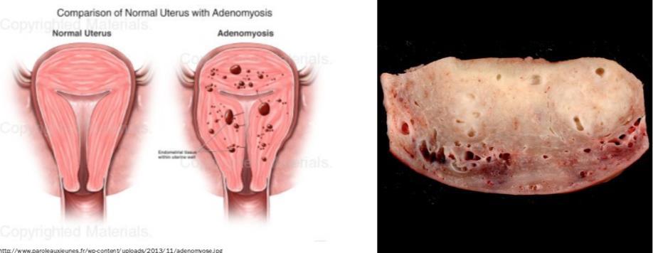 Adenomyosis: This is defined as the presence of endometrial glands and endometrial stroma in the myometrium of the uterus.