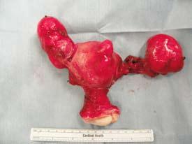 Kaku S, et al. : A Case of Primary Ovarian Adenomyoma 235 Fig.
