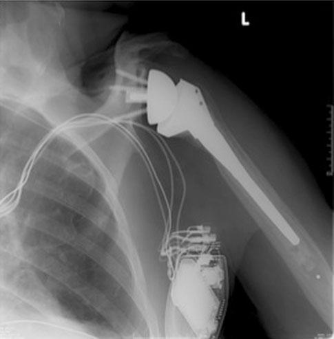 Scapular Notching in Reverse TSA function (18% preoperatively to 56% postoperatively), mean Constant-Murley score (29 to 64), and mean Constant-Murley pain score (5.2 to 10.5).
