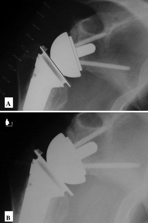 Scapular Notching in Reverse TSA discussed in this paper. The senior author (GPN) is a designer and received royalties for this implant.