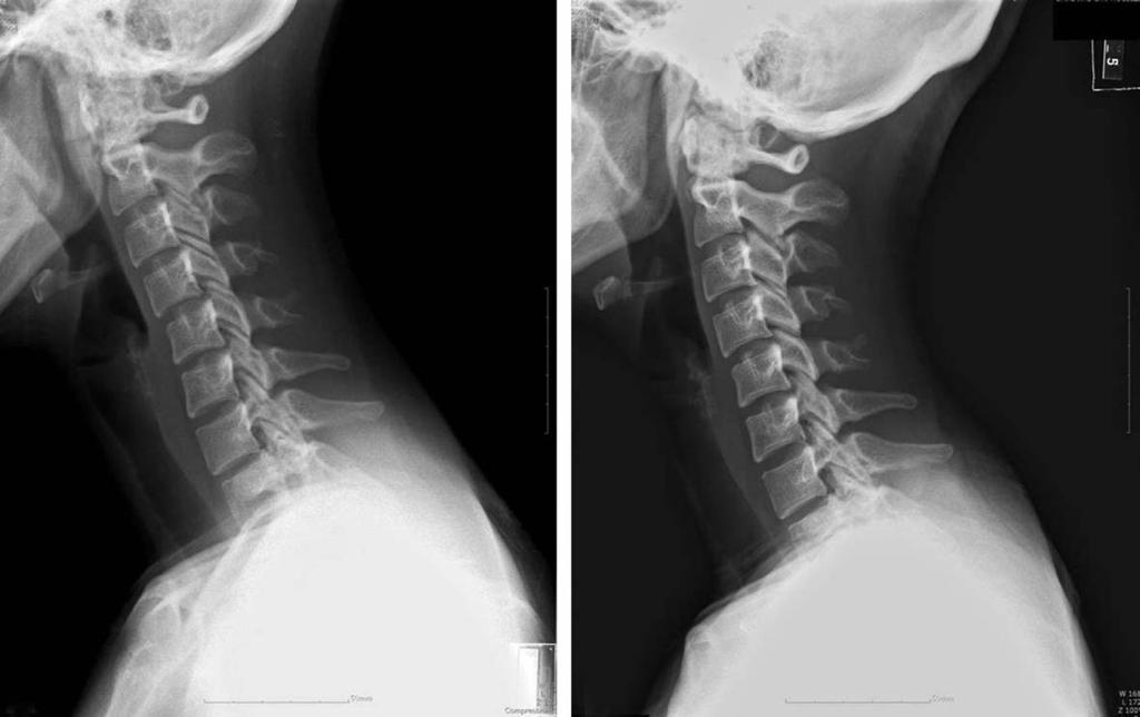 124 / ASJ: Vol. 4, No. 2, 2010 rior arch. The follow-up X-rays after 1month showed considerably improved prevertebral swelling with retropharyngeal calcific tendinitis of the longus colli (Fig. 1).