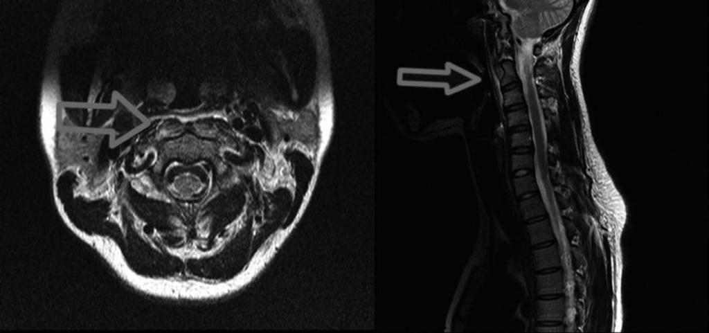 Calcific Prevertebral Tendinitis / 125 ing conservative treatment, including anti-inflammatory drugs and rest.