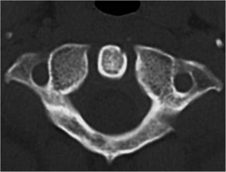 Figure 4. No soft tissue calcification in an unenhanced CT of cervical spine.