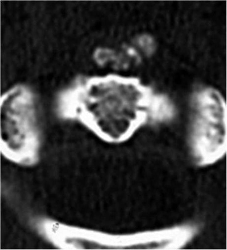 elevation of WBC and CRP. The radiographic findings include swelling of the retropharyngeal space and amorphous calcification anterior to C1-C2 in lateral view of the cervical spine.
