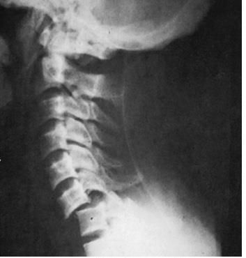Cervical Spine Conditions (cont.